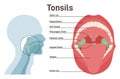 Tonsils. Human lymphoid organs. Immunocompetent organs at the back Royalty Free Stock Photo