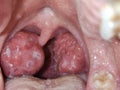 Tonsils. Swollen tonsils with plaque due to acute anguineous.