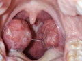 Tonsils. Swollen tonsils with plaque due to acute anguineous.