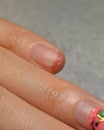 Too grown nail gel-coated break off and injure the skin under the nail plate