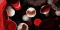 Too many white blood cells due to leukemia Royalty Free Stock Photo