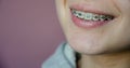 Tooth alignment with braces. Beautiful caucasian young girl in dental braces smiles. Teenage concept. Royalty Free Stock Photo