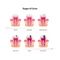 Tooth anatomy and decay chart. Vector biomedical illustration. Cross section. Stages of teeth caries isolated on white background Royalty Free Stock Photo