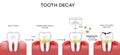 Tooth Caries And Cavity