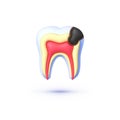 Tooth caries in 3d style. 3d vector isolated icon. Vector illustration