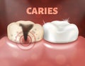 Tooth with caries and healthy tooth. 3d realistic illustration of dental disease. Deep caries on a sick tooth