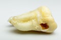 Tooth with caries - macro photo. Tooth decay with enamel and dentin caries, pulpits and periodontists. White background.