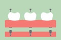 Dental prostheses, filling denture on gum