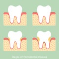 Step of periodontal disease / periodontitis / gingivitis / gum disease, dental problem Royalty Free Stock Photo