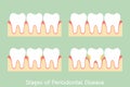 Step of periodontal disease / periodontitis / gingivitis / gum disease, dental problem Royalty Free Stock Photo