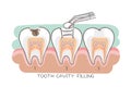 Tooth cavity filling Royalty Free Stock Photo