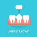 Tooth crown. Dentistry and implant procedure concept