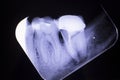 Tooth crown root canal