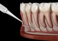 Tooth Cystectomy Surgery - recovery after Periostitis . Medically accurate 3D illustration Royalty Free Stock Photo