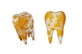 tooth 3D Model with Plaque, Virus, germs, fungi, bacteria. Stain dirt clinging to teeth on white background. Cause tooth decay.