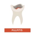 Tooth decay caries stage dentistry and dental health pulpitis