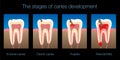 Tooth Decay Caries Stages Development Black Background