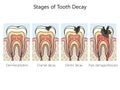 Tooth decay caries stages diagram medical science Royalty Free Stock Photo