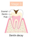 Tooth decay symptom, dentin cavity. Dental and oral health care concept.