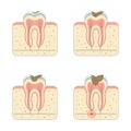 Tooth decay disease