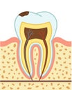 Tooth decay Royalty Free Stock Photo