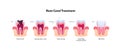 Tooth decay and root canal treatment chart. Vector biomedical illustration. Cross section. Teeth in gum feeling steps isolated on