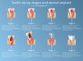 Tooth decay stages and dental implant vector illustration