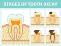 Tooth decay stages Royalty Free Stock Photo