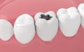 Tooth decay, unhealthy teeth, 3d rendering