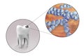 Tooth with dental caries