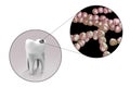 Tooth with dental caries