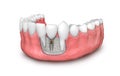 Tooth dental implant model 3d illustration