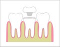 Tooth endocrown concept illustration. Endodontic crown process of installation. Royalty Free Stock Photo