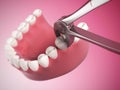 Tooth extraction Royalty Free Stock Photo