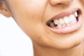 Tooth extraction and oral health