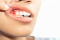 Tooth extraction and oral health