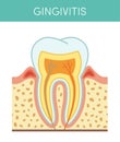 Tooth with gingivitis