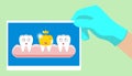 Tooth with golden dental crown icon in cartoon style on a white background.