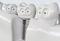 Tooth human cartoon implant - 3D Rendering Royalty Free Stock Photo