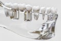 Tooth human implant - 3D Rendering Royalty Free Stock Photo