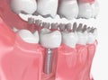 Tooth human implant - 3D Rendering