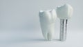 Tooth human implant - 3D Rendering Royalty Free Stock Photo