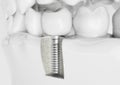 Tooth human implant - 3D Rendering Royalty Free Stock Photo