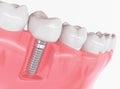 Tooth human implant - 3D Rendering Royalty Free Stock Photo