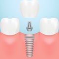 Tooth Human Implant. Dental Concept. Human Teeth Or Dentures Isolated On A Background. Vector Illustration. Royalty Free Stock Photo