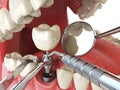 Tooth human implant. Dental implantation concept. Human teeth or Royalty Free Stock Photo