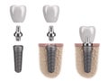 Tooth human implant