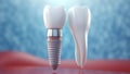 Prosthetic Tooth and Dental Implant Technology - Dental Implant and Natural Tooth Comparison