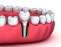 Tooth human implant, Medically accurate illustration white style