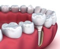 Tooth implant and crown installation process. Medically accurate